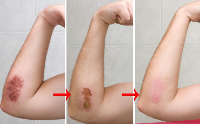 4921964 Cover healing