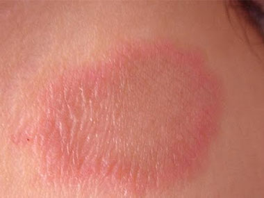 dieu tri benh vay nen