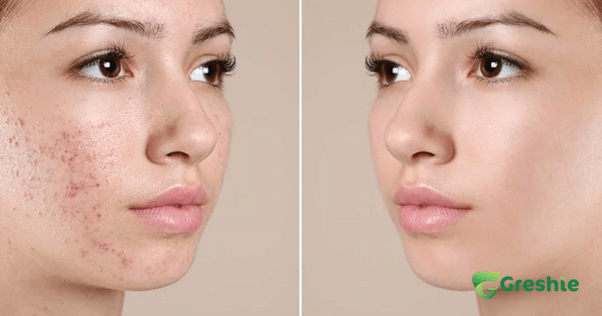 Giam Mun va Vet Tham