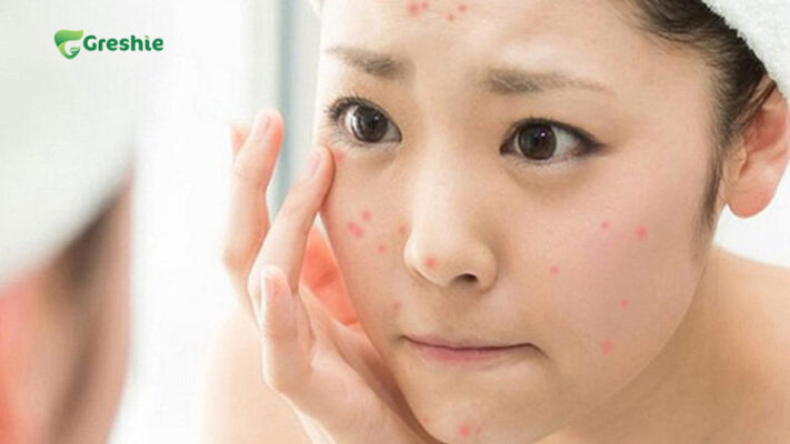 Loi Ich Cua Nuoc Ep Dep Da Giam Mun