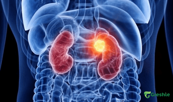 Nguoi co benh than man tinh