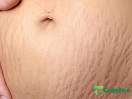 Ran da sau sinh la gi