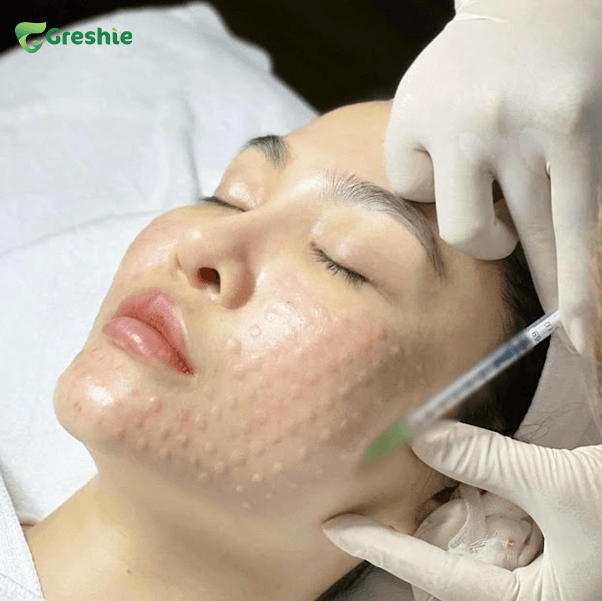 kim vi diem hoac thiet bi tiem chuyen dung de dua duong chat vao sau trong da